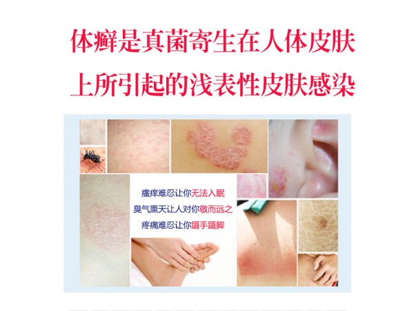 溢美癬立凈