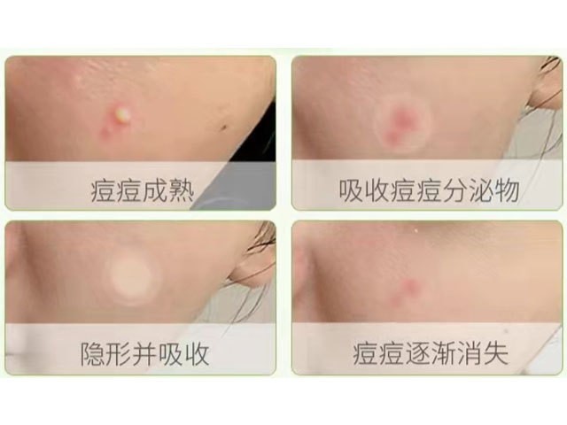一次性使用無(wú)菌敷貼（痘痘貼）